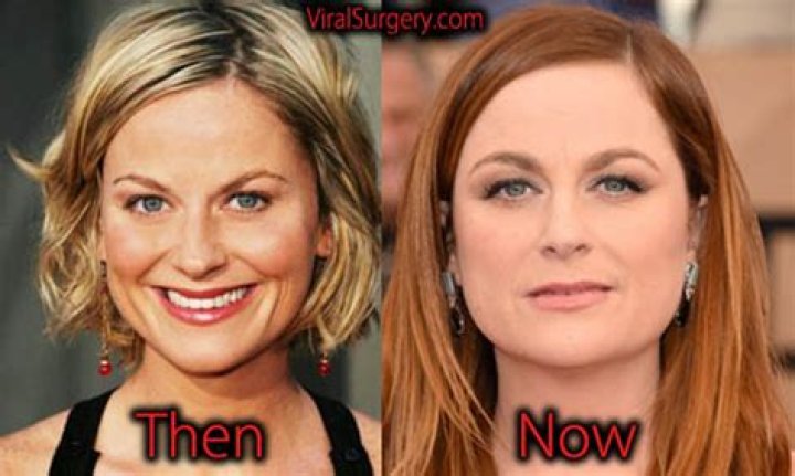 Amy Poehler get facelift