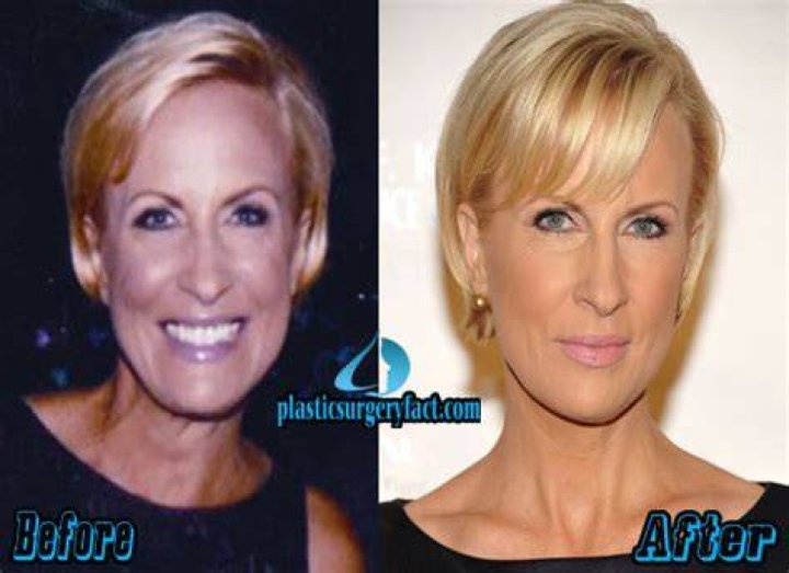 Mika Brzezinski Plastic Surgery