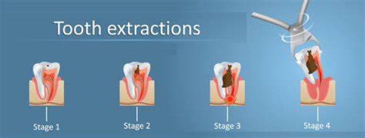 tooth extraction procedure