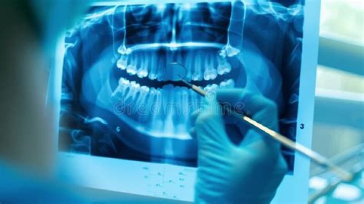 X-rays for extraction