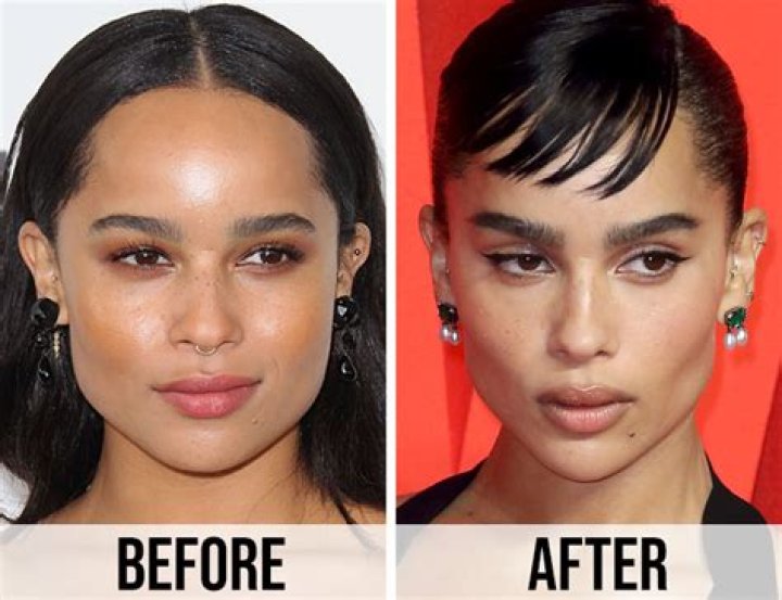 Zoe Kravitz Buccal Fat Removal and Changes in Looks